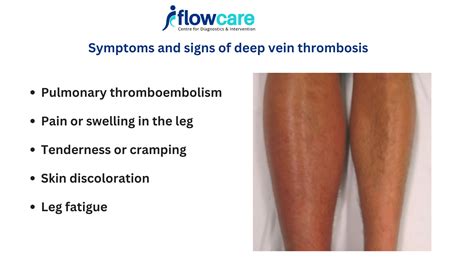Thrombosis: Symptoms & Treatment .